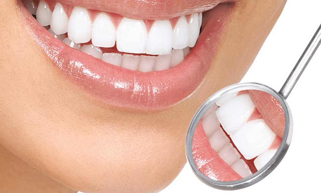 بلیچینگ دندان در شاهین شهر