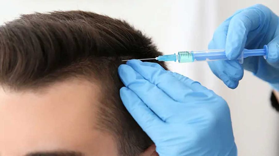مزوتراپی بعد از کاشت مو